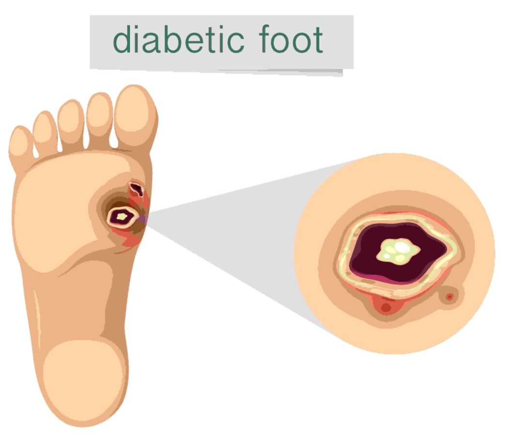 diabetic foot pain