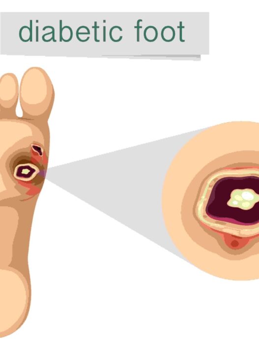 diabetic foot pain