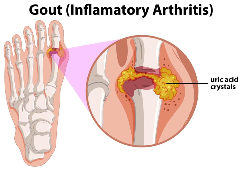 Foot joint with Gout inflammatory arthritis due to uric acid crystals forming tophi