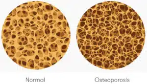 Osteoporosis, Bone