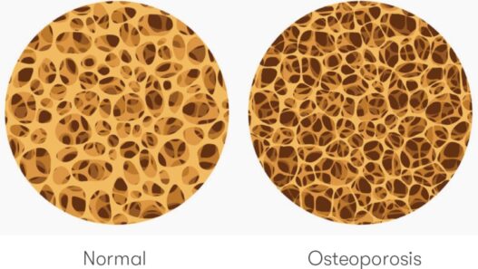 Understanding Osteoporosis vs Osteopenia