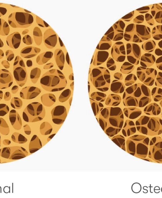 Understanding Osteoporosis vs Osteopenia