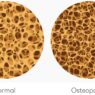 Understanding Osteoporosis vs Osteopenia