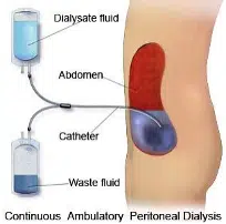 CAPD, peritoneal dialysis