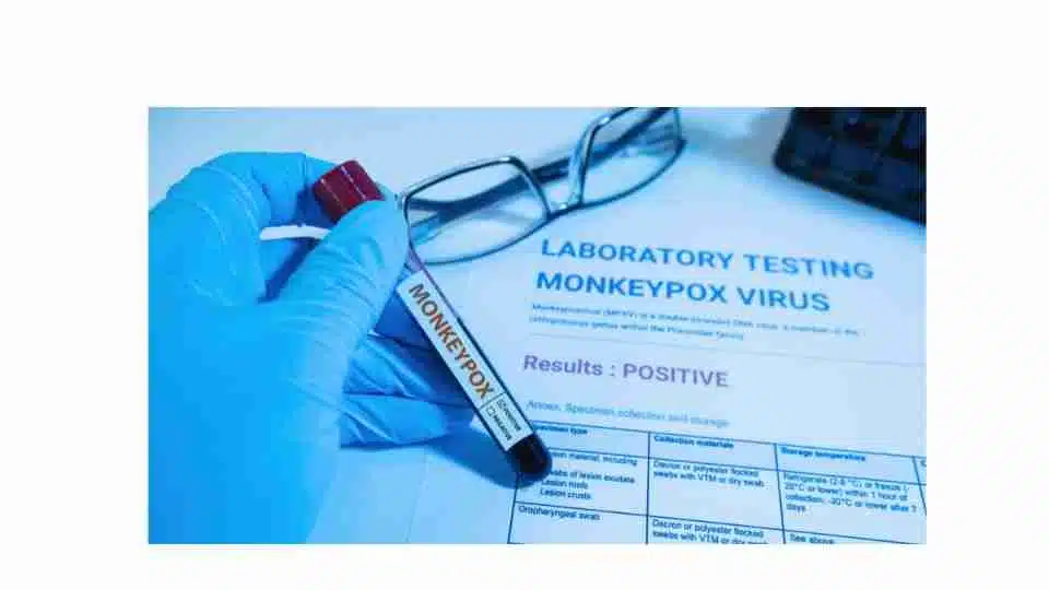monkeypox 2022, monkeypox virus disease outbreak, Monkeypox, diagnosis, lab test, symptoms, cases, MPXV, monkeypox pictures