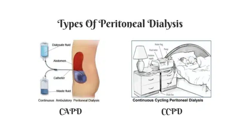 Peritoneal dialysis types, CAPD, CCPD, hemodialysis vs peritoneal dialysis, catheter