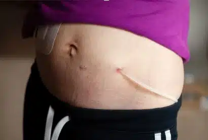 peritoneal dialysis complications and tube in stomach