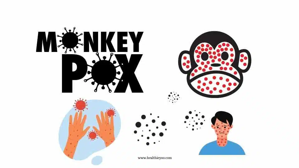 Monkeypox pictures, MPXV, Monkey Pox, Monkeypox 2022