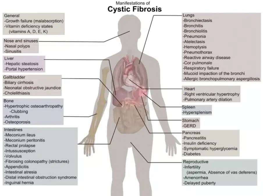 Cystic fibrosis manifestations, CFRD, CFLD