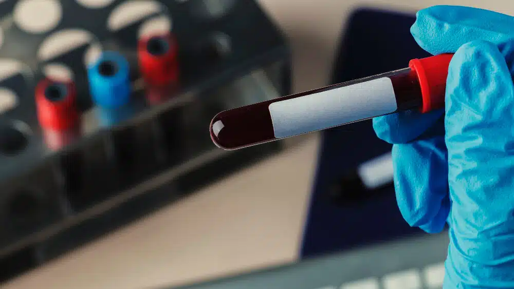 holding test tube for lab test, RDN, renal registered dietitian