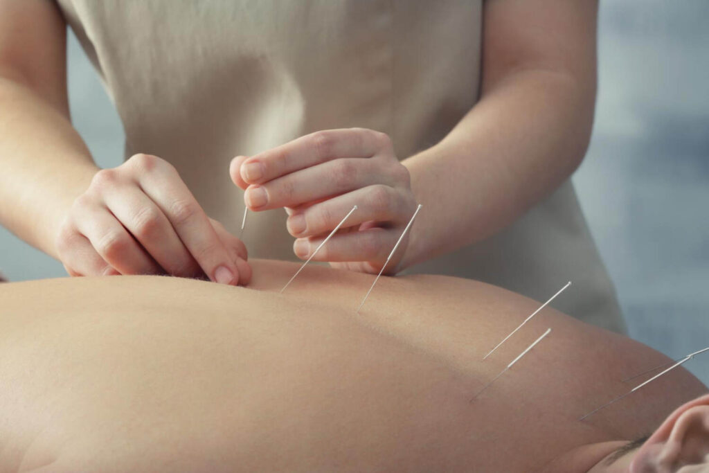 female doing acupuncture for pain relief on back of another person using needles