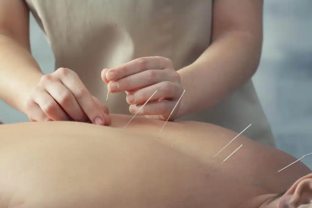 female doing acupuncture for pain relief on back of another person using needles